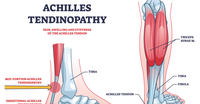 Stepping Strong: A Guide to Achilles Tendinopathy Rehabilitation Exercises  image